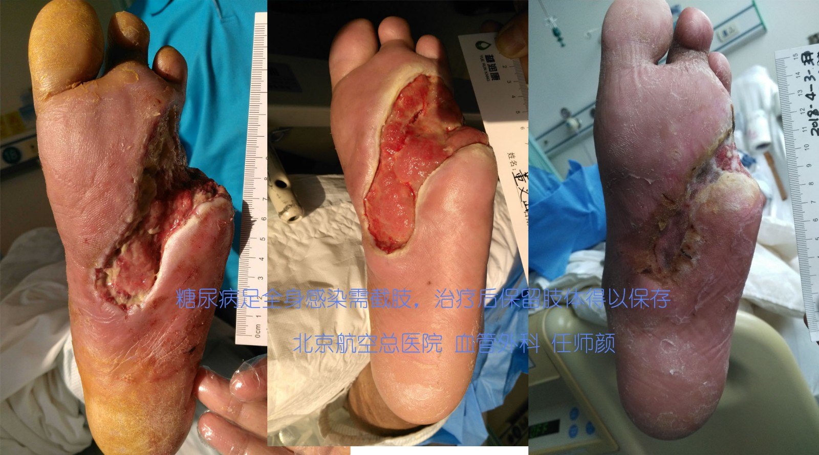 修脚后感染截肢保命，警惕日常护理中的隐患与应对之道
