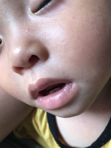一岁宝宝鼻子旁边长一粒粒小豆豆是什么？全面解析与应对建议