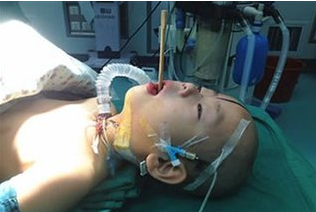 男童在幼儿园遭遇筷子插鼻穿孔事件，深度分析与反思