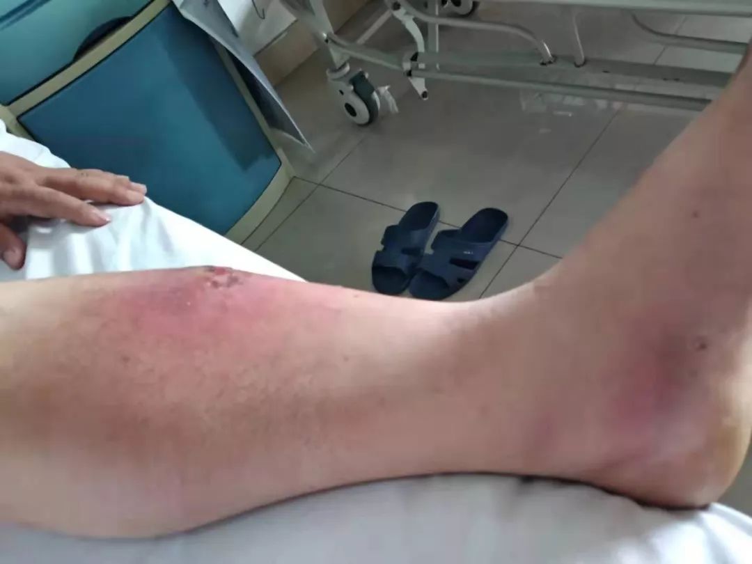 腿被烧烤签子扎伤引发肿块，全面解析与处理指南
