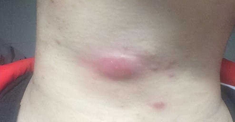 身上发痒竟确诊肝癌？揭开肝癌与皮肤症状的神秘面纱