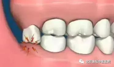女牙医亲自拔智齿，全程面不改色