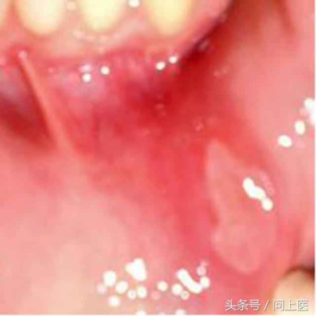 口腔溃疡与HPV感染的区别解析