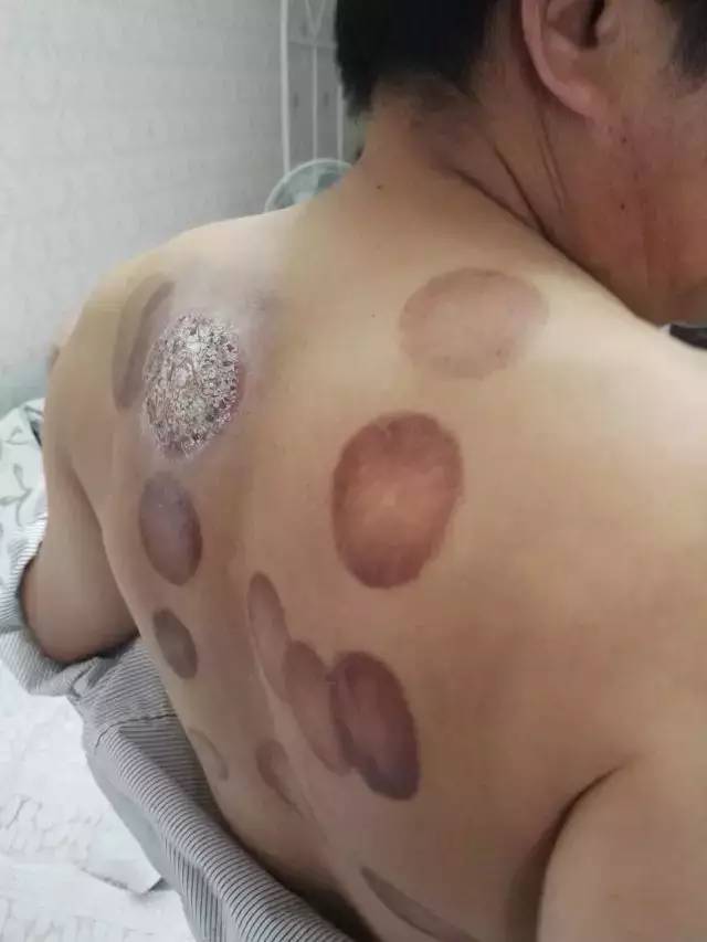 拔火罐死亡事件，深度探究与反思