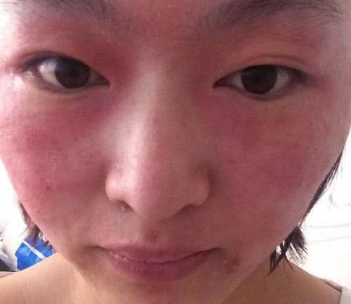过敏是一种状态