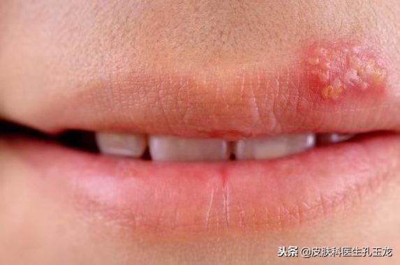 女子使用话筒后感染单纯疱疹病毒