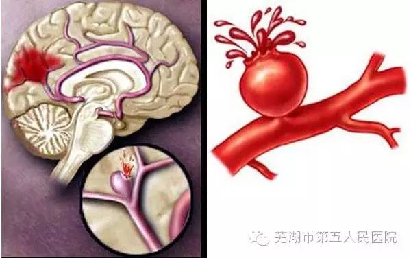 脑干出血宣布死亡还有奇迹吗？探寻生与死的边界