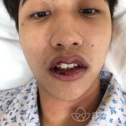 男子突然变丑，下唇比上唇厚一倍，背后的故事引人深思