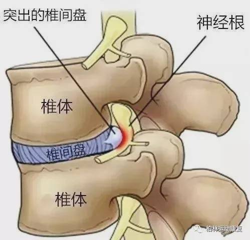 每天撞树能治颈椎腰椎病吗？揭秘真相与科学建议