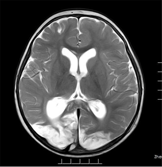 撞树锻炼致椎体坏死能恢复吗？深度解析与恢复可能性探讨