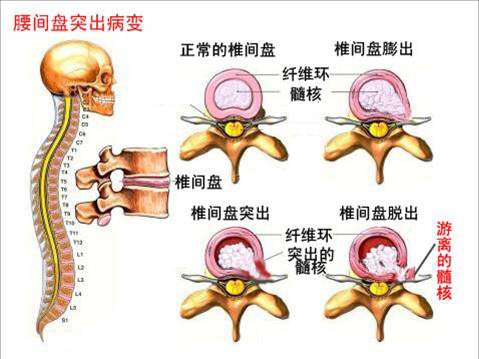 撞树锻炼会导致椎体坏死吗？解析背后的真相与风险