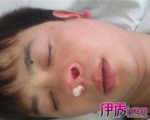 苟伟死因曝光，鼻息肉肥大致呼吸骤停