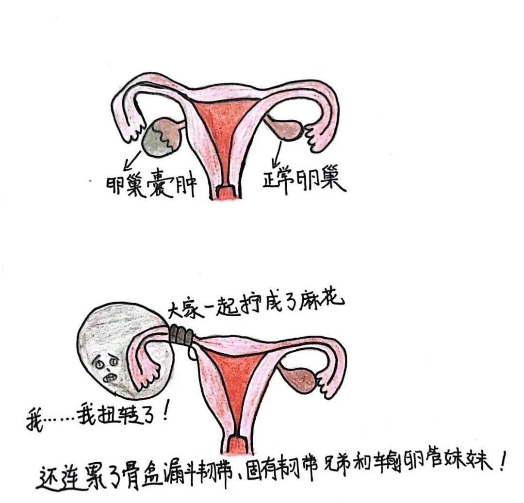 女孩肚痛竟查出卵巢扭曲如麻花，四圈之痛引发关注
