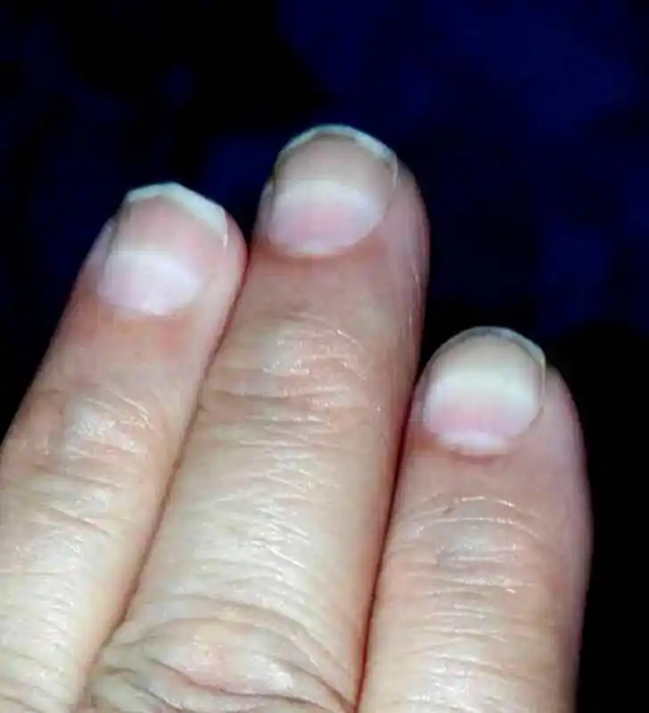 揭秘铊中毒背后的故事，一名三岁女童的脱发之谜