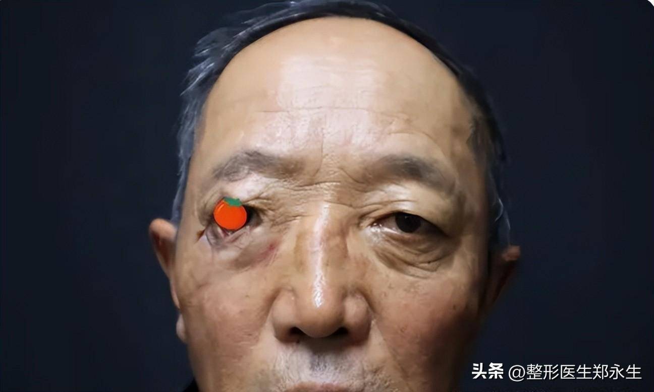 七旬大爷出门散步被拉去割眼袋，警惕老年人的生活陷阱