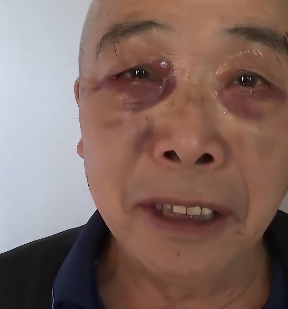 七旬大爷出门散步被拉去割眼袋，警惕老年人的生活陷阱