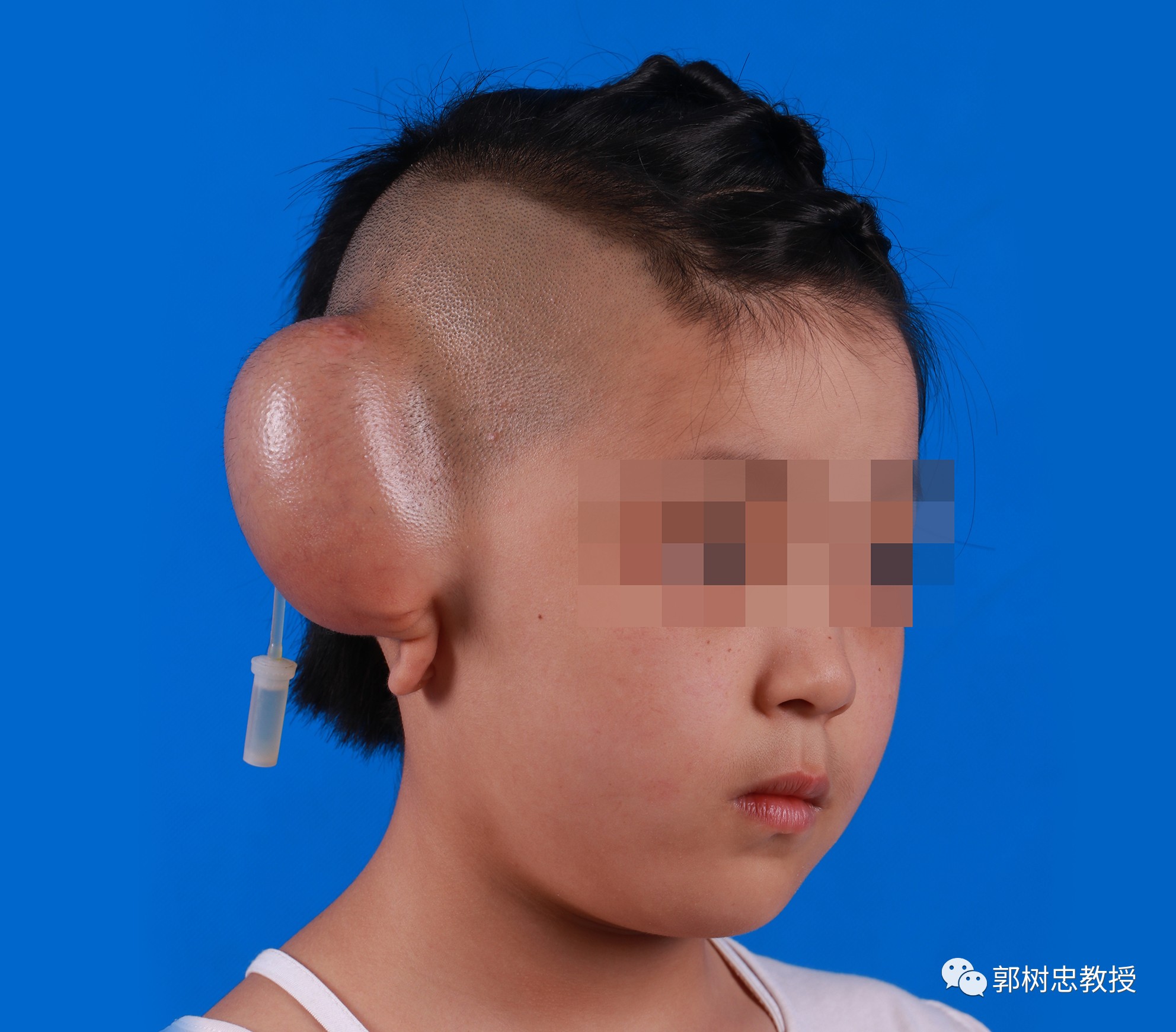患罕见病男孩成功摘除头部扩张器，重燃生命之光