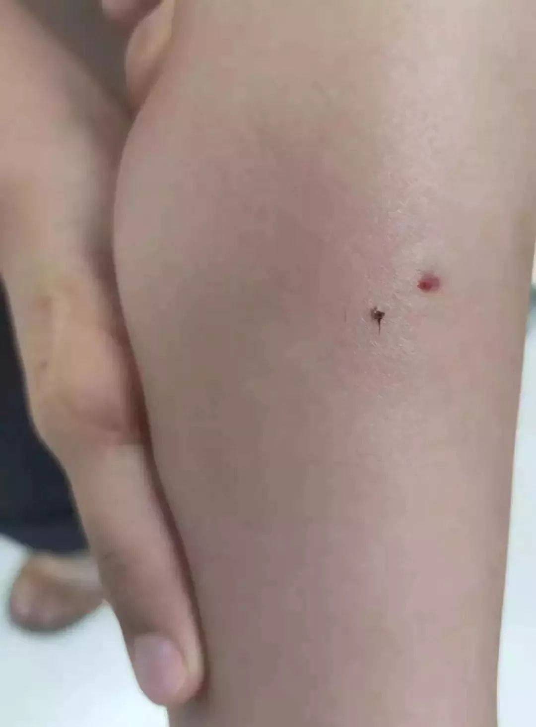 幼童遭遇蜜蜂蛰咬事件解析