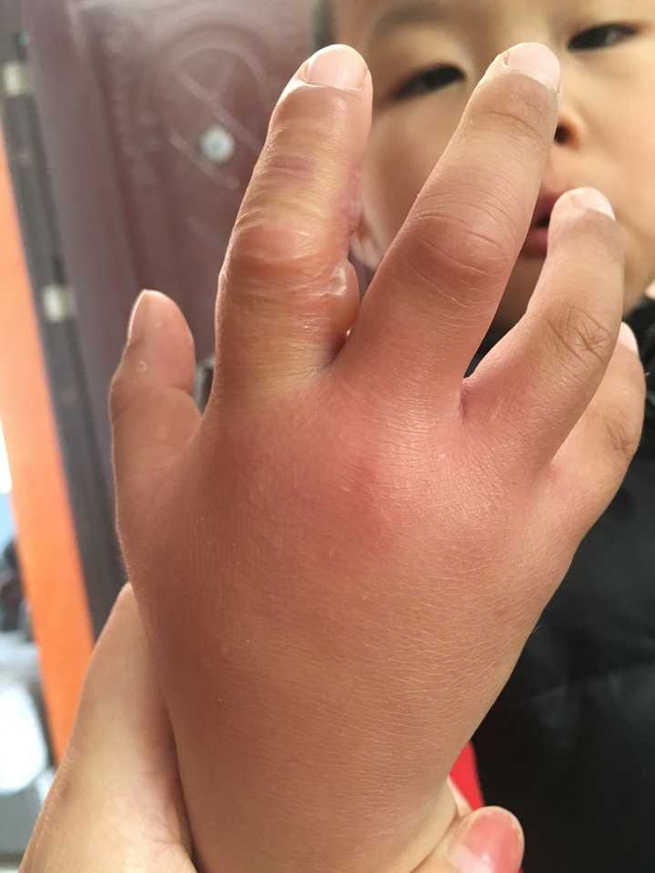 小孩被蜜蜂蛰了会不会有危险