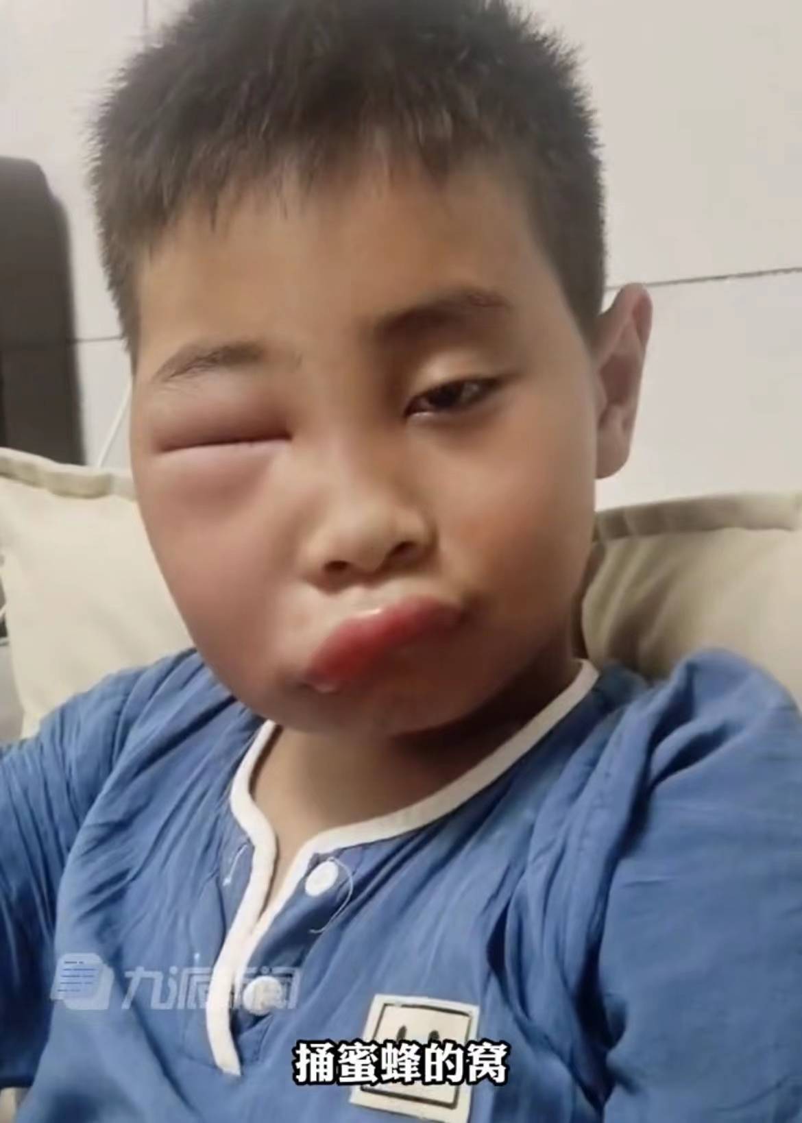 小孩被蜜蜂蛰了会不会有危险