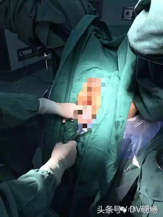 男子花巨款屁股整形后遭遇肛门功能受损事件