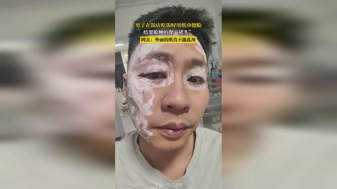 廉价纸擦脸肿成猪头，一场哭笑不得的荒诞经历