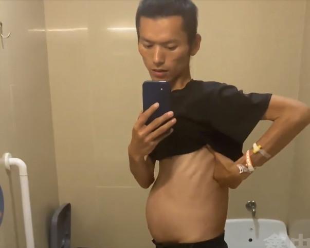 腹泻一年暴瘦至67斤，健康问题解析与应对建议