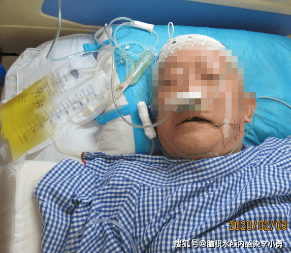男子晨起洗澡引发颅内动脉瘤破裂，深度解析事件背后的健康警示
