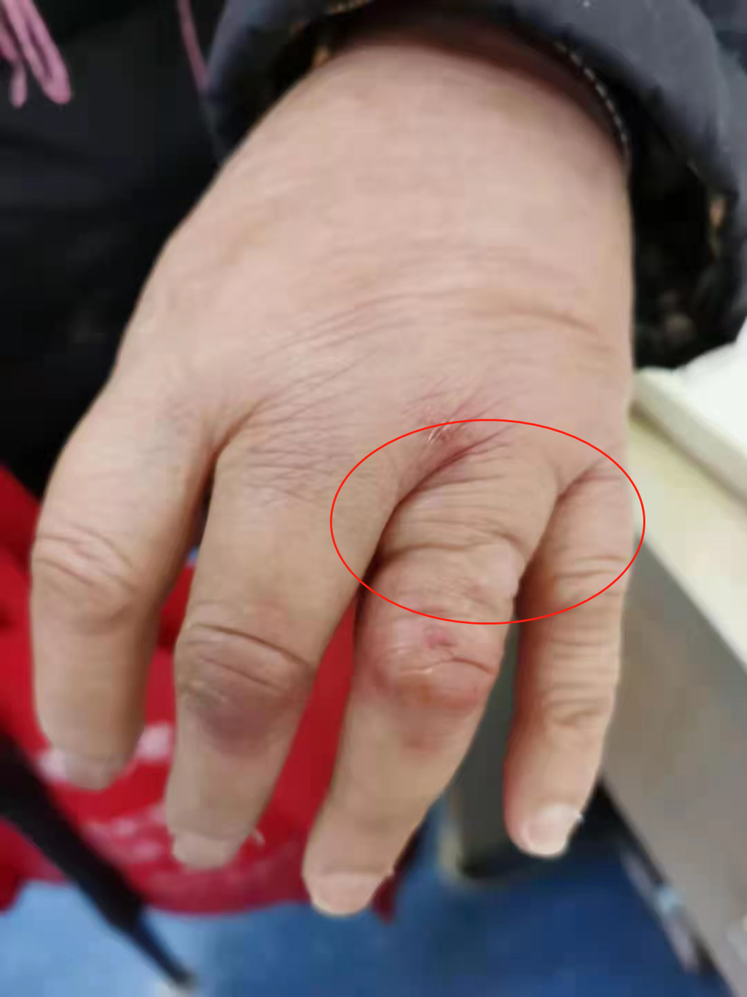 多位捏捏玩家出现喉咙痛烂手指——游戏健康隐患探讨