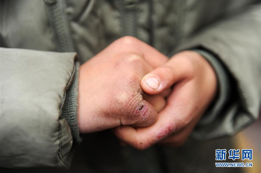 七旬老人捡烟花被伤，社会的警醒与我们的行动