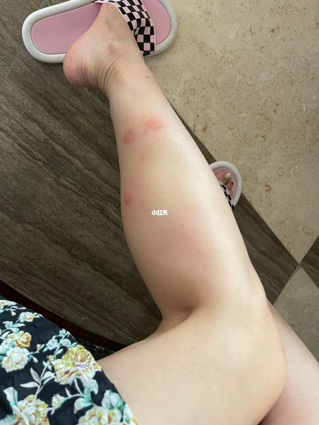三亚海边游玩遭遇不测，被咬后整个腿都肿了