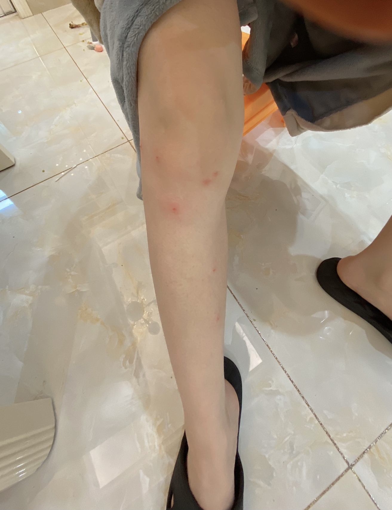 三亚海边游玩遭遇不测，被咬后整个腿都肿了