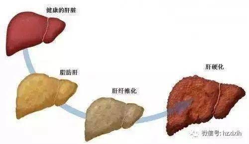 肝纤维化是一种什么病？需要治疗多少钱？全面解读